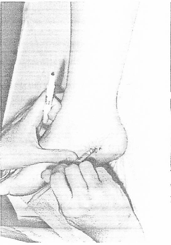 Palpation technique to locate a heel neuroma, Figure 3a.