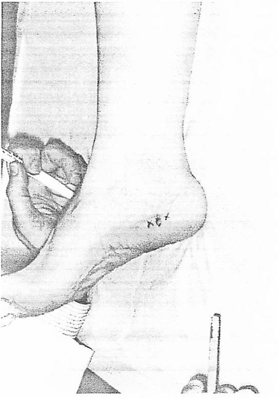 Palpation technique to locate a heel neuroma, Figure 3b.