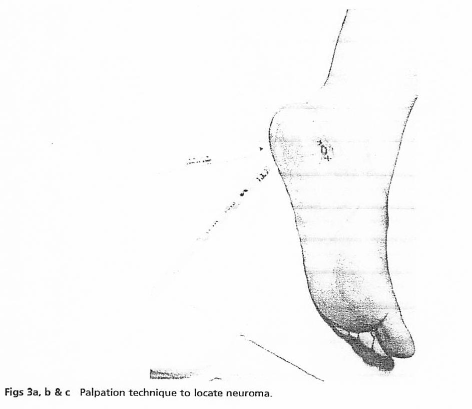 Palpation technique to locate a heel neuroma, Figure 3c.