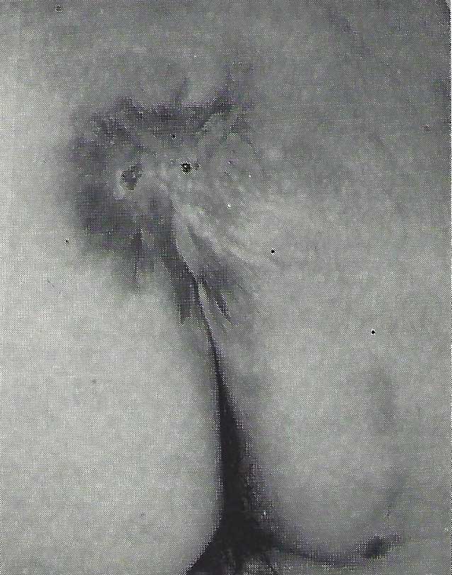 Historical photograph of the same patient six months after treatment.