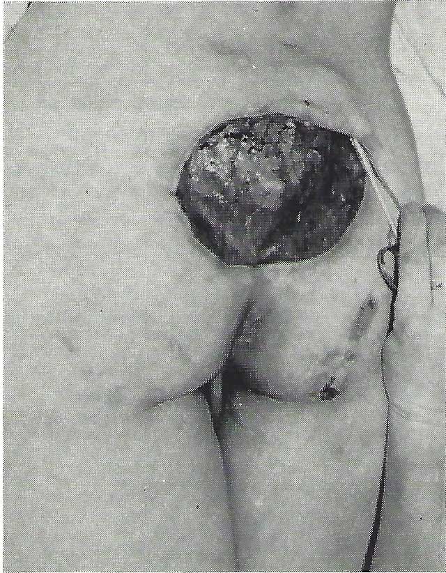 Pre-treatment historical photograph of patient D.J. with a bed-sore in the sacral area.
