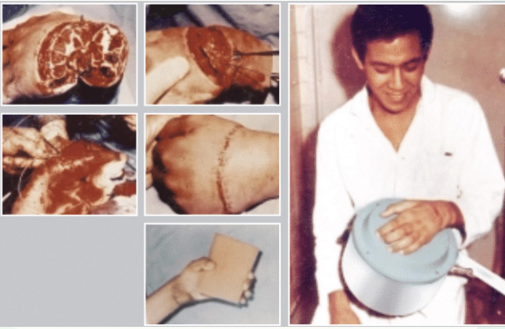 Clinical photographs documenting hand injury treatment in the Diapulse brochure.