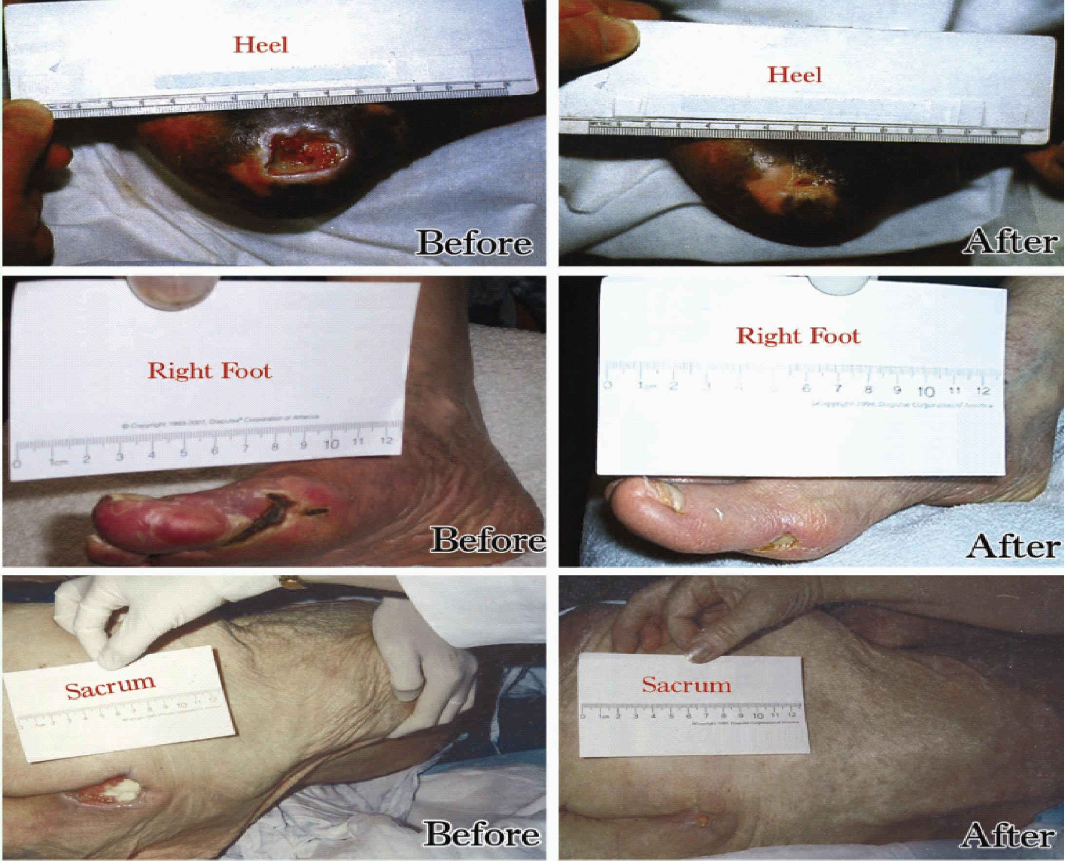 Before-and-after wound-care photographs from the Diapulse brochure.