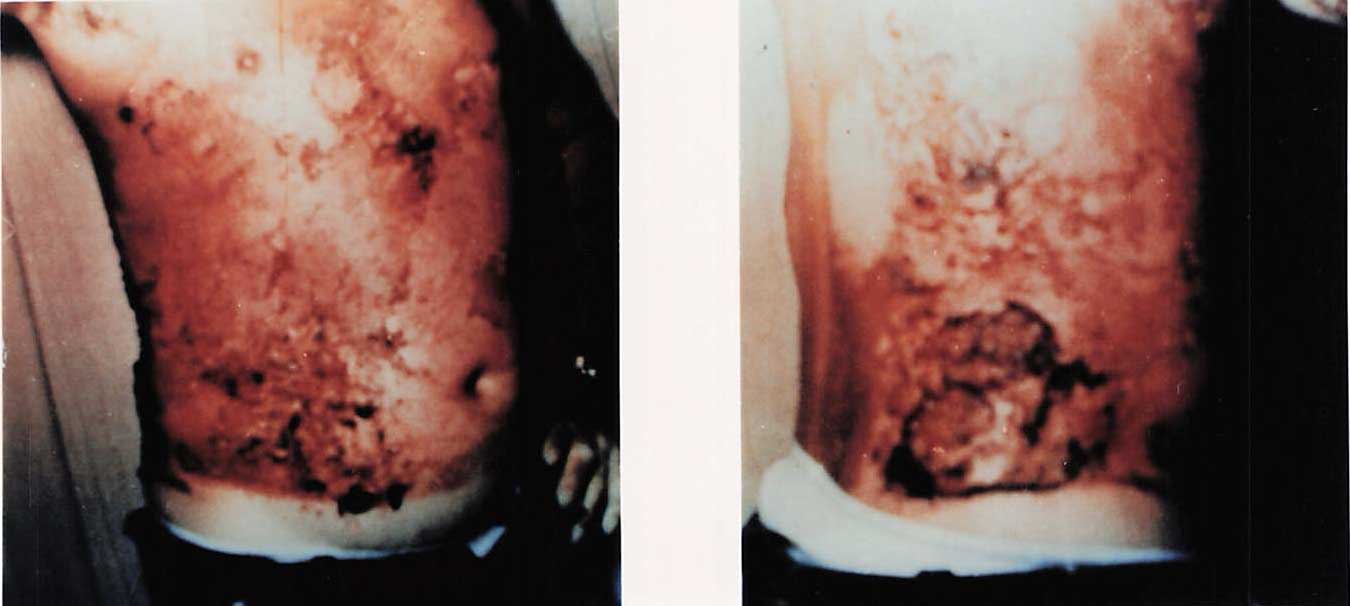 Front and back photographs of a burned thorax, labeled 1A and 1B