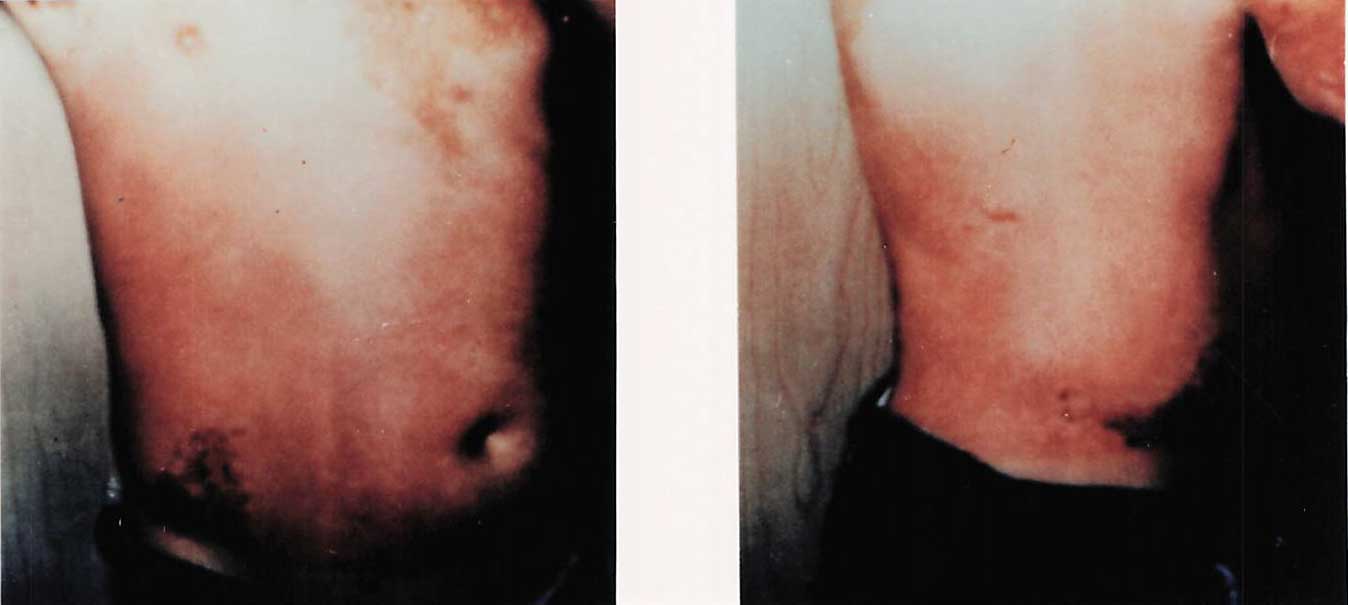 Front and back photographs of the thorax after treatment, labeled 2A and 2B